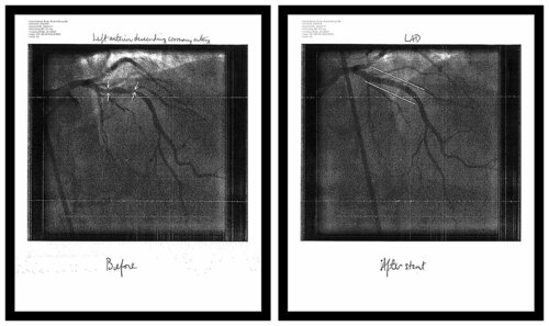 "Work # 698: Before and After Updated (Stent)" von Bruce Eves, Fotografie kaufen auf Singulart